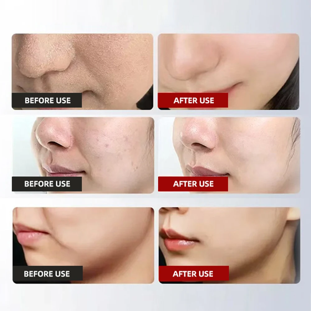 

Лифтинг лица, укрепляющий омолаживающий массажер для уменьшения морщин для домашнего использования, устройство для подтяжки кожи и уменьшения морщин