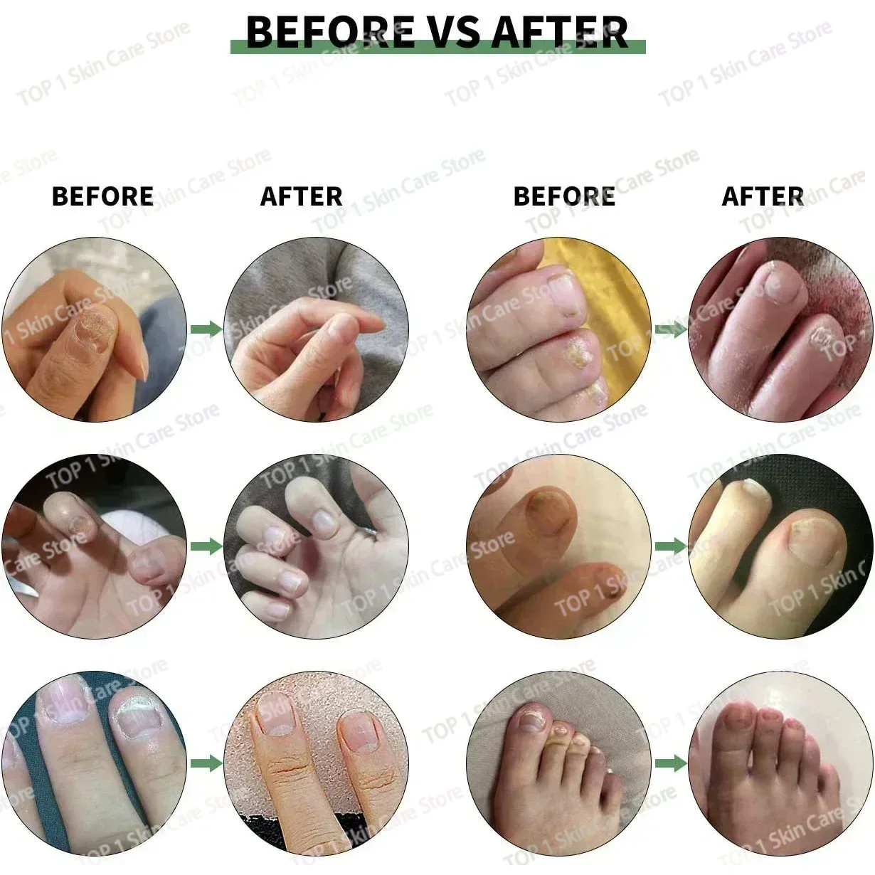 Newanti เล็บการติดเชื้อกำจัด Onychomycosis เล็บสีเทาลบลบเชื้อราคุดเล็บเท้าดูแล paronychia CRE