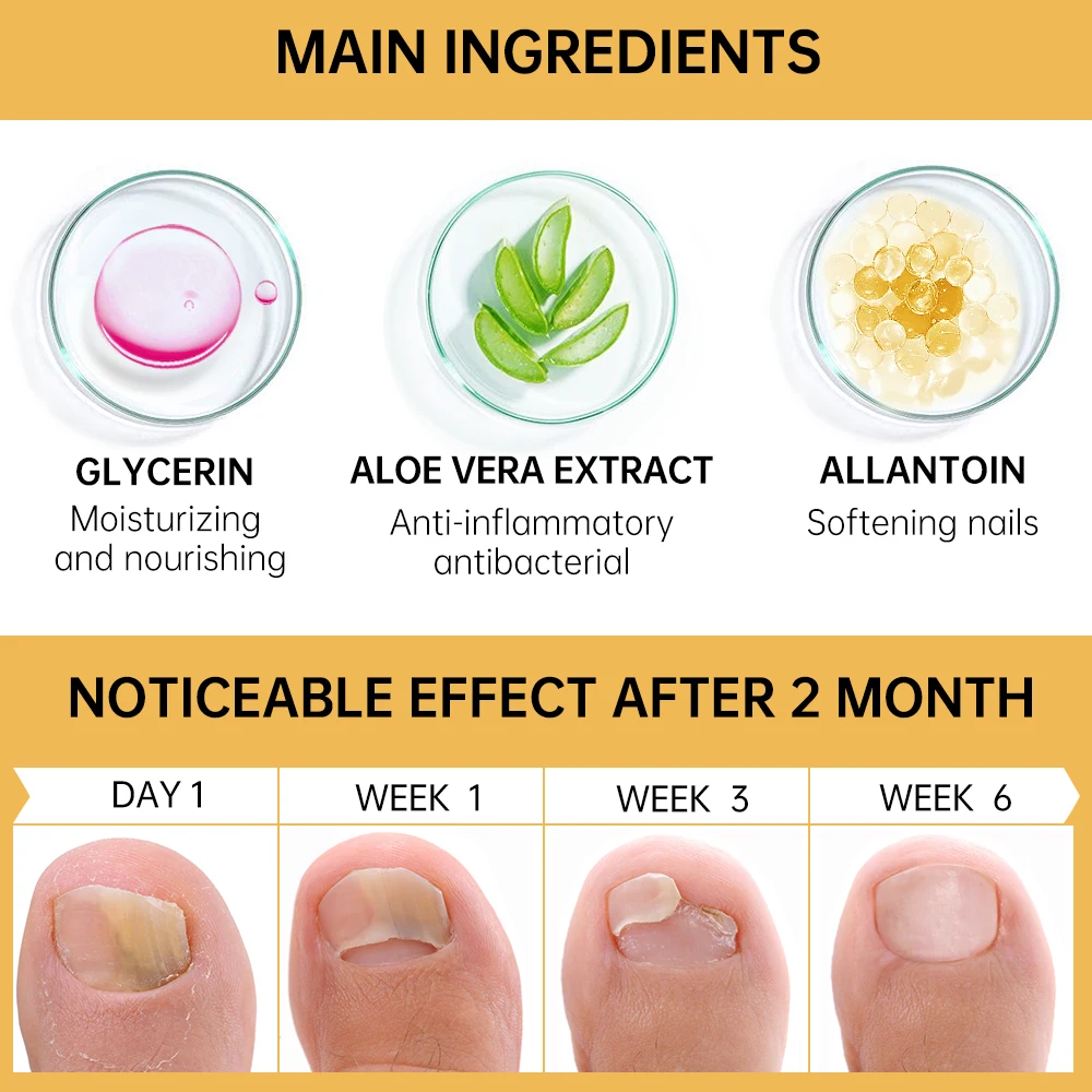 JoyPretty-Nail Fungal Tratamento Soro, Anti Infecção, Reparação Essência, Renovação do prego Nutritivo Gel, Unha Cuidados Produtos, Beleza