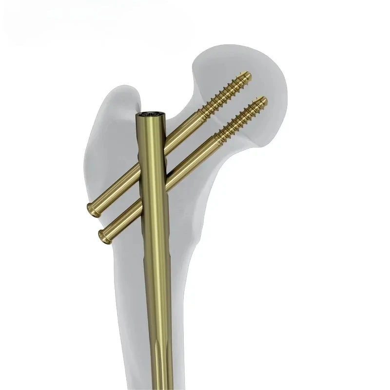 Femoral Reconstruction Intramedullary Interlocking Nail with Orthpaedic Instruments [Materials & Accessories]