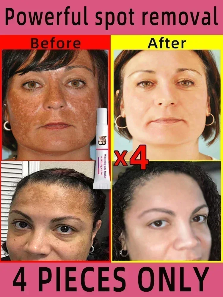 Venda quente manchas faciais creme remoção de sardas pele mancha escura remover melasma manchas de idade manchas solares clareamento e remoção de sardas cr