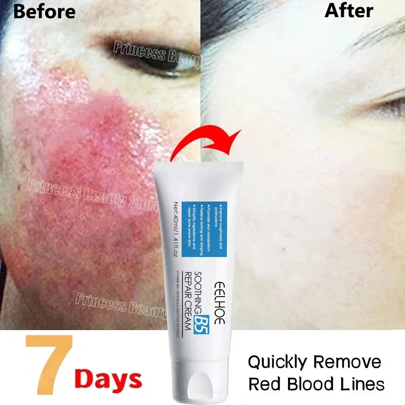 Facial Redness Repair Cream Improve Sensitive Skin Dryness Moisturizer Hydrating Sooth Lotion Removal Rosacea Korean Cosmetics