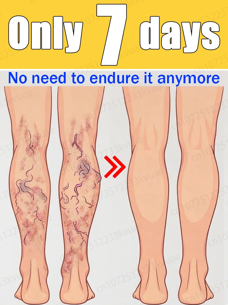 

Tʀᴇᴀᴛ ᴠᴀʀɪᴄᴏsᴇ ᴠᴇɪɴs sᴀғᴇʟʏ ᴀɴᴅ ᴇғғᴇᴄᴛɪᴠᴇʟʏ, ʀᴇᴍᴏᴠᴇ ᴠᴀʀɪᴄᴏsᴇ ᴠᴇɪɴs