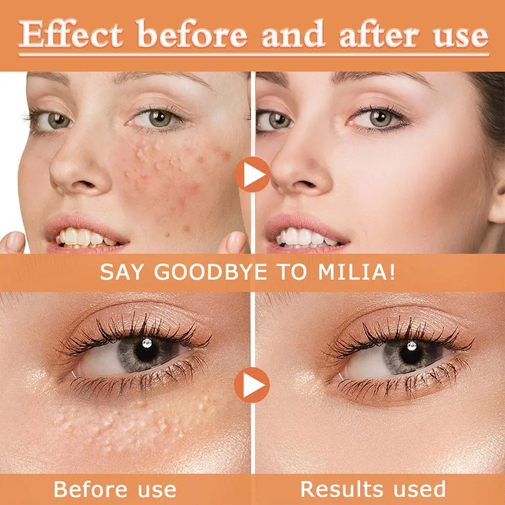 30ml Milia Clearing Essence Remover Essence Fat Granule Essence Acne Under Serum Skin Anti Eye Milia Clearing Anti Repair A J0G6