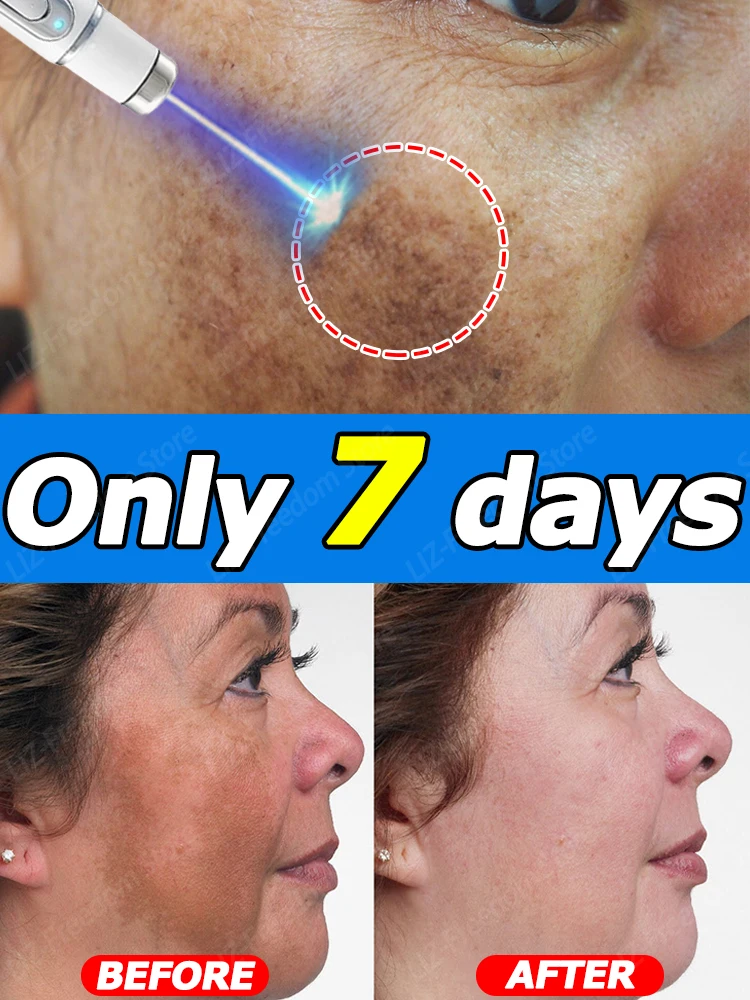 

Facia Dark Spots Dsappeared