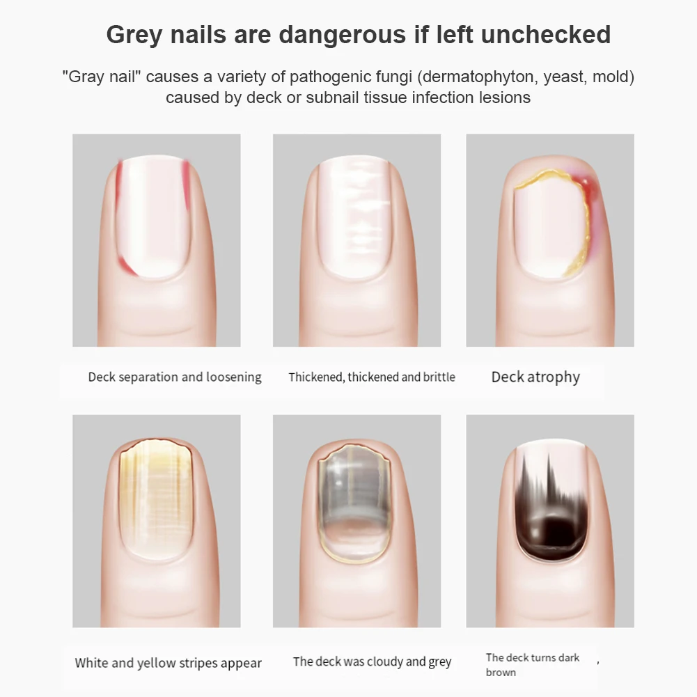 

Nail Fungal Light Device Fungal Discolored Remover Portable Nail Fungal Eradication Device Rechargeable for Nail Deformation
