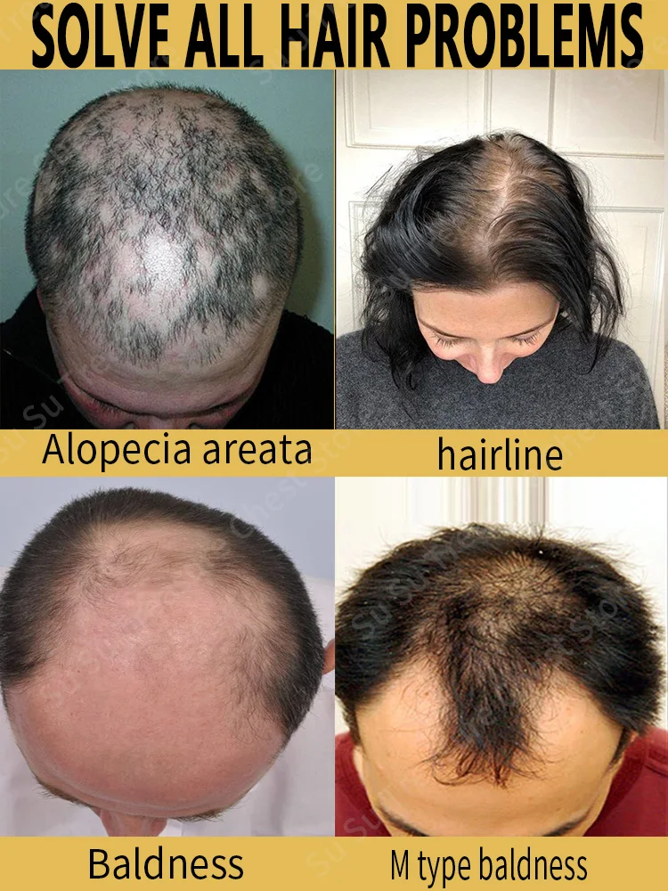 اشتر 5 واحصل على 5 مجانًا من زيت الشعر العضوي المبيعات الساخنة، مناسب للشعر الكثيف والطويل عرض خاص