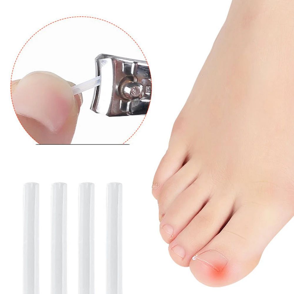 10 Stks/set Voetverzorging Tool Behandeling Bunion Paronychia Ingegroeide Nail Pad Groove Ortho Correctie Pads Teennagel Corrector