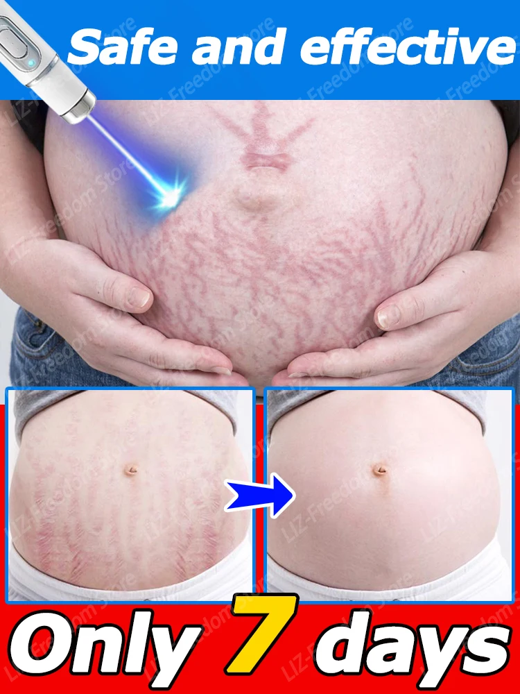 

Stretch Marks Cream Eliminate Belly Swelling Skin Cracks Repair Firming Care