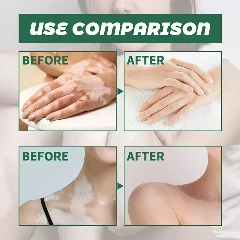 Remove White Spot Removal Skin Vitiligo Eliminate Vitiligo Body Skin Care