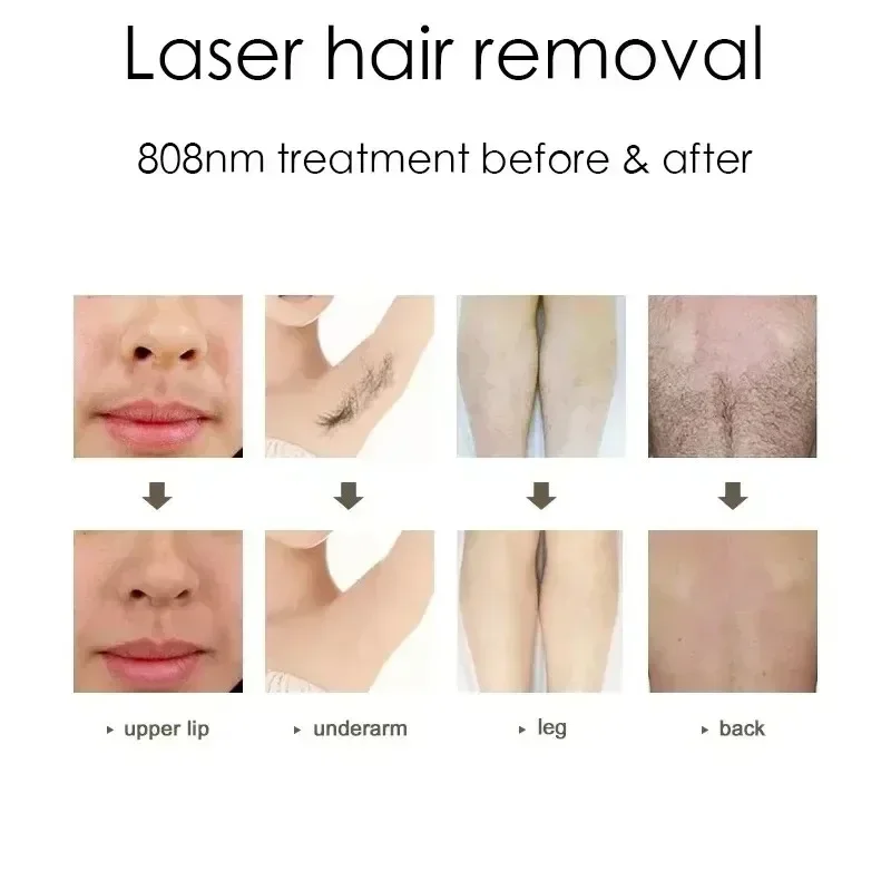 Professional  laser nd yag laser Beauty Removal Q Switch colaser tattoo removal machine diode laser hair removal machine