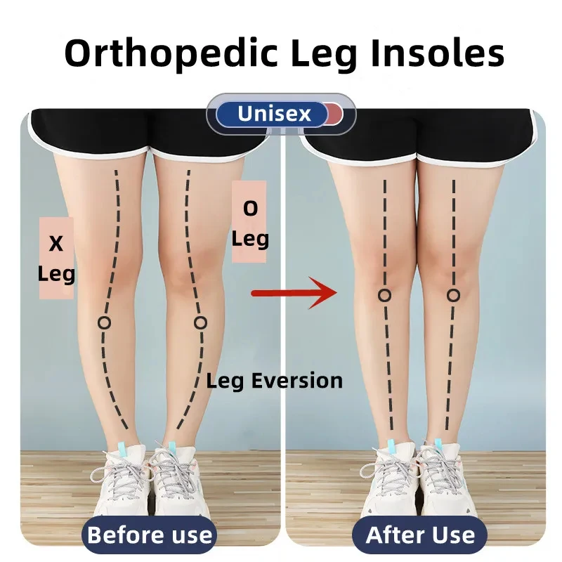 Semelles orthopédiques en silicone pour la correction des pieds en O/X (valgus/varus), fasciite plantaire, semelles en gel avec aimants pour massage et soin des pieds