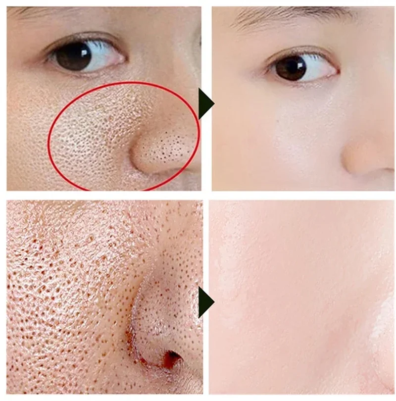 サリチル酸毛穴縮小血清クイック除去大きな毛穴除去にきびにきび引き締め滑らかな肌韓国ケア製品