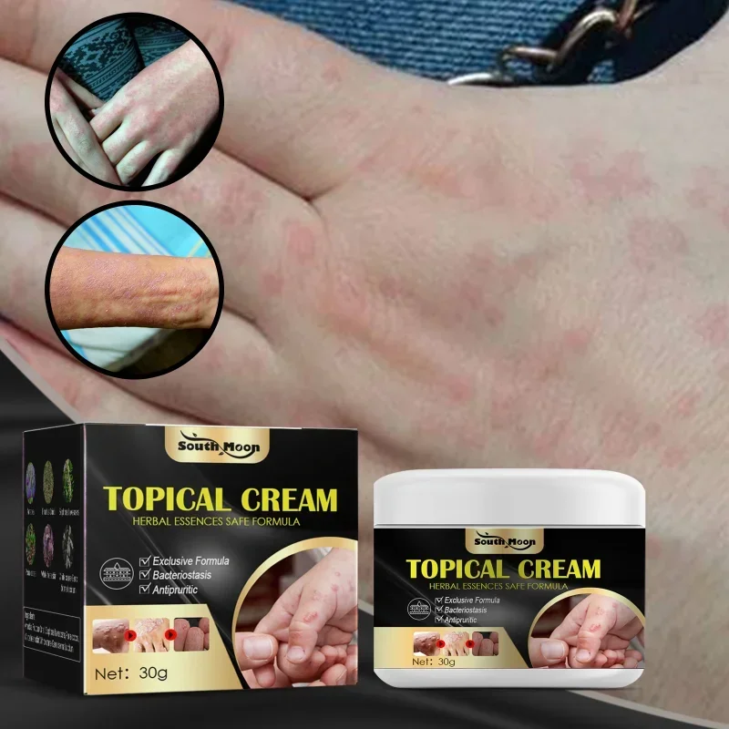 Pomada profesional antiprurítica para manos y pies, tratamiento para la piel seca, antipicaduras de mosquitos, crema tópica, yeso Herbal para el cuidado de la piel