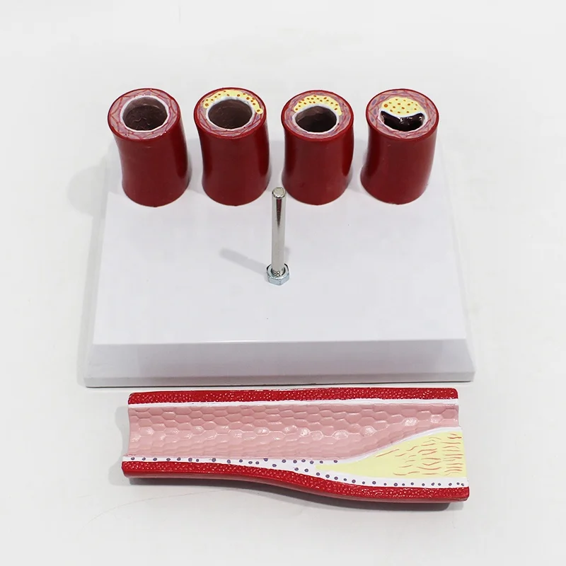 Scientific model of medical education, vascular model, pathological blood anatomy of different stages