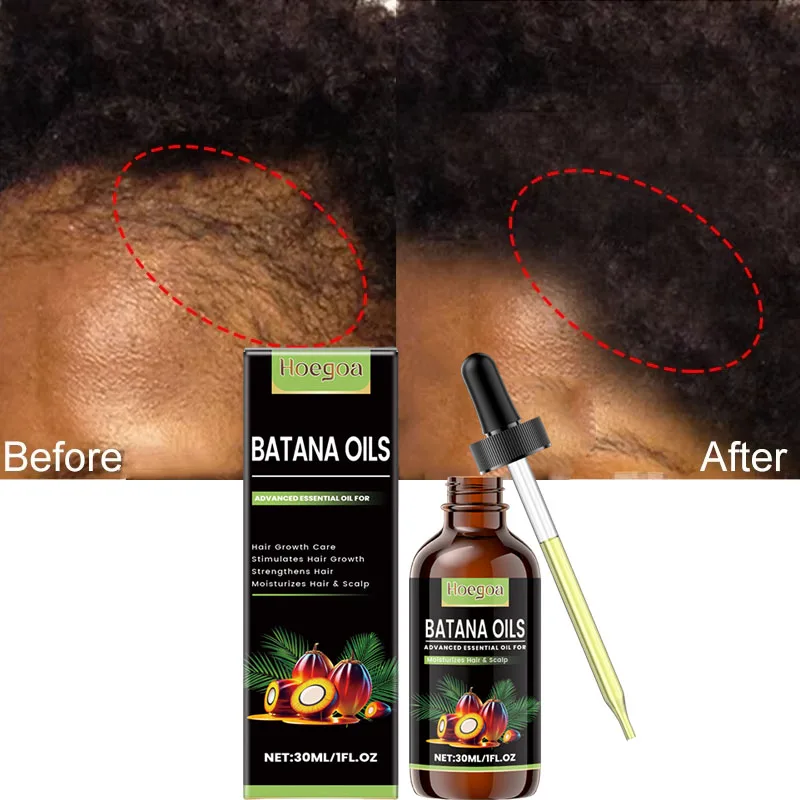 

Fast Hair Growth Oil Africa Crazy Traction Alopecia Batana Hair Mask Anti Hair Break Hair Beard Eyelash Strengthener Hair Care