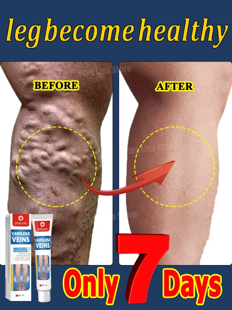 Varicose Vein Repair Hot Selling