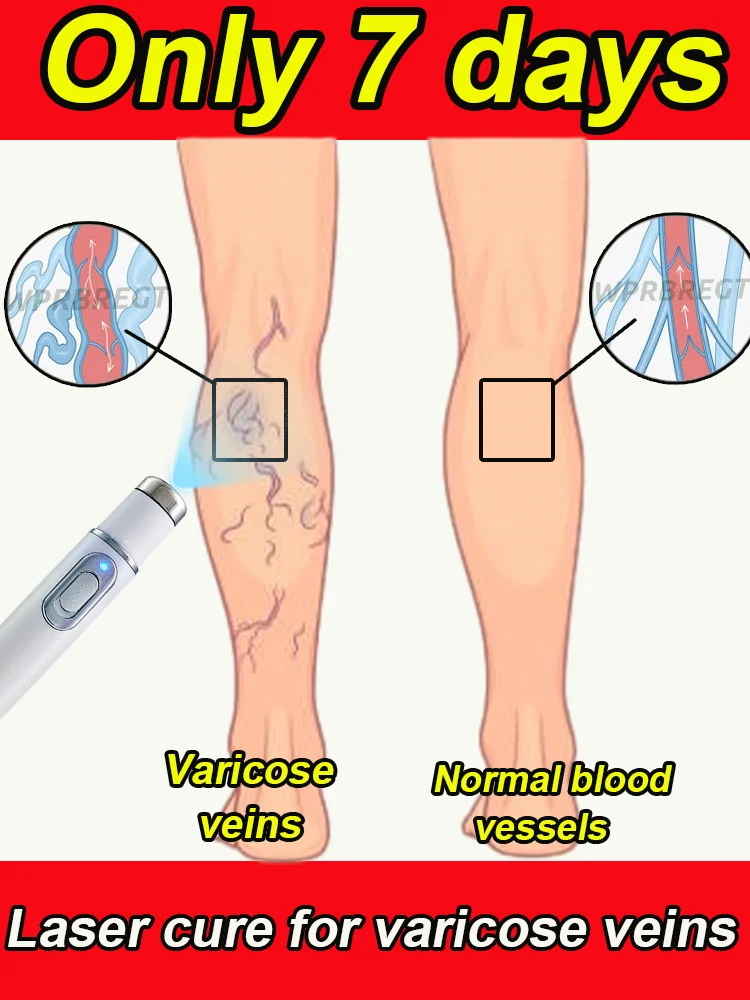 

Sedentary office workers and students with varicose veins promote blood circulation and improve venous blockage