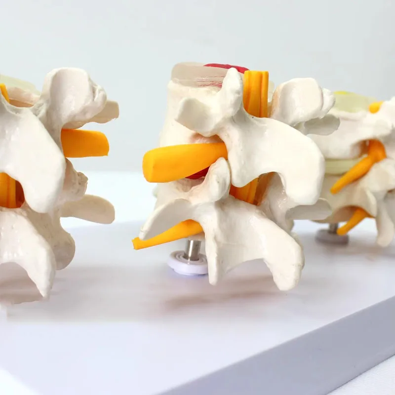 4-stage Pathological Human Lumbar Spine Anatomy Model Medical Science Teaching Tool