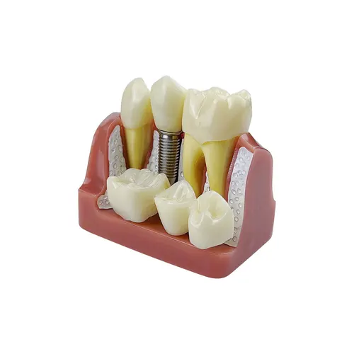 Imagen 2 del producto Modelo de análisis decorativo Modelo de enseñanza de demostración de puente de corona, estudio de formación extraíble, 4 veces