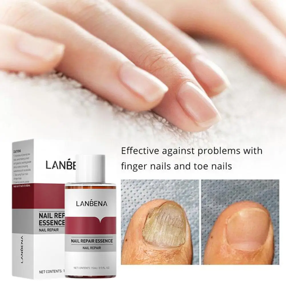 15ml LANBENA Fungal Nail Treatment Feet Care Essence Fungus Infection Paronychia Healthy Serum Repair Removal Onychomycosis T4N4
