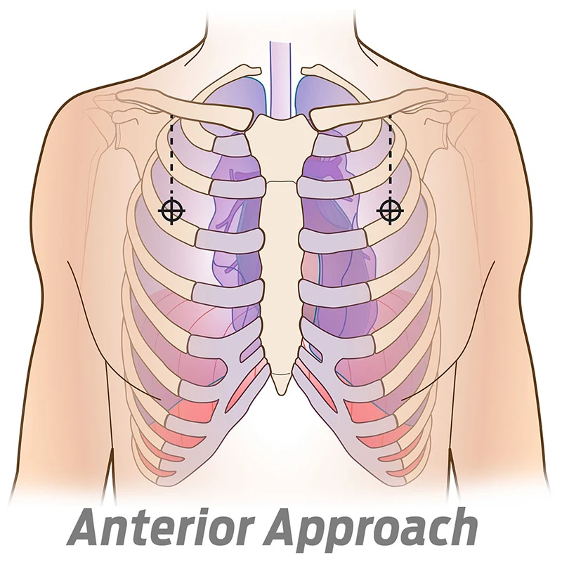 Design Notfall ausrüstung Erste-Hilfe-Kit Spannung Pneumothorax Thorax Nadel medizinische Brust Dekompression nadel