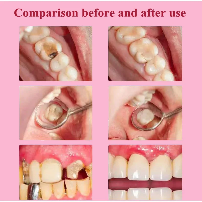 

Sdottor New Repair of Cavities Caries Removal of Plaque Stains Decay Whitening Yellowing Repair Teeth Whitening New toothpaste