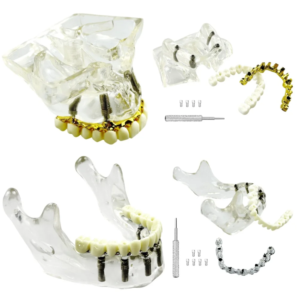 

Модель зубного протеза, 4 имплантататы, верхняя щелочная пазуха, 6 имплантатов, модель восстановления нижней щелочной стоматологии для обучения