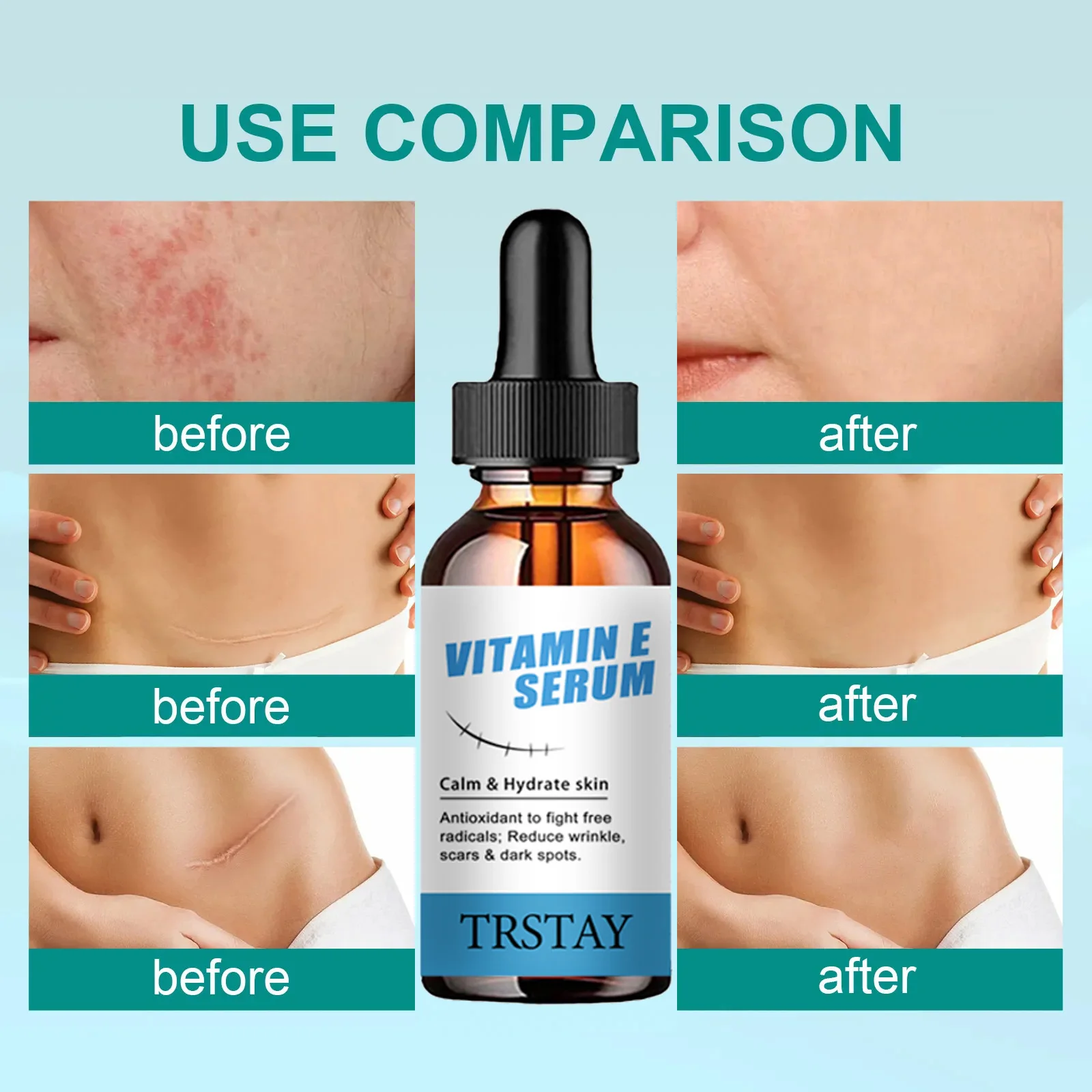 TRSTAY فيتامين E جوهر العناية بالبشرة مرطب التجاعيد الحد من الندبات والبقع يتلاشى للعناية بالحمل Striae Gravidarum #4