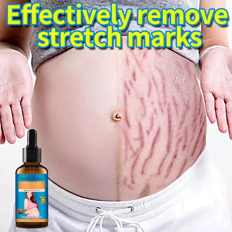 Say Goodbye to Stretch Marks Pregnant Women Stretch Marks Removal Nourishing Belly Serum Bio Oil Restores Natural Smoothness