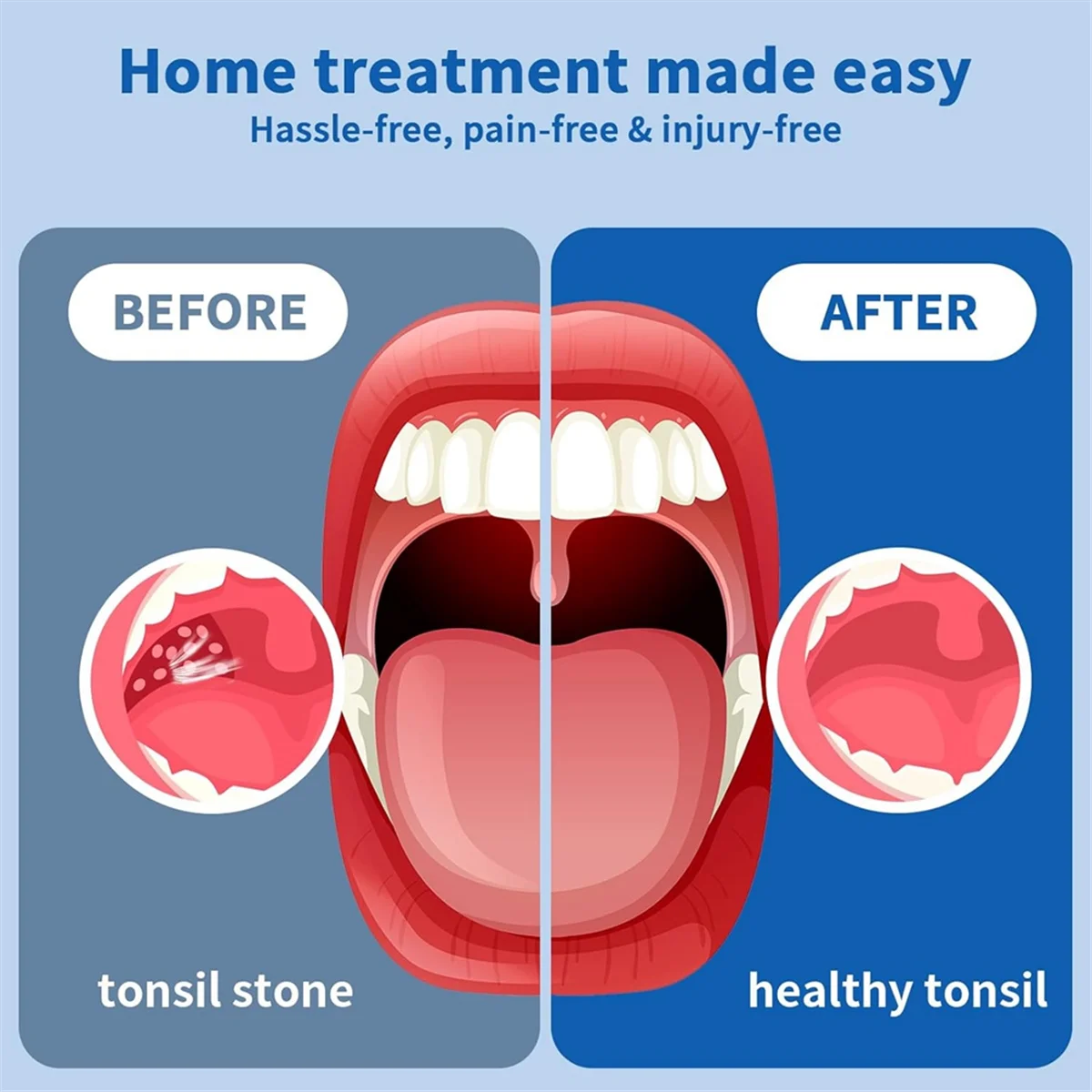 【24 ساعة للبيع!】{مزيل حجر اللوزيل الإلكتروني، مجموعة إزالة حجر اللوزيل 10 في 1، مكنسة حجر اللوزيل مع ضوء أزرق مدمج