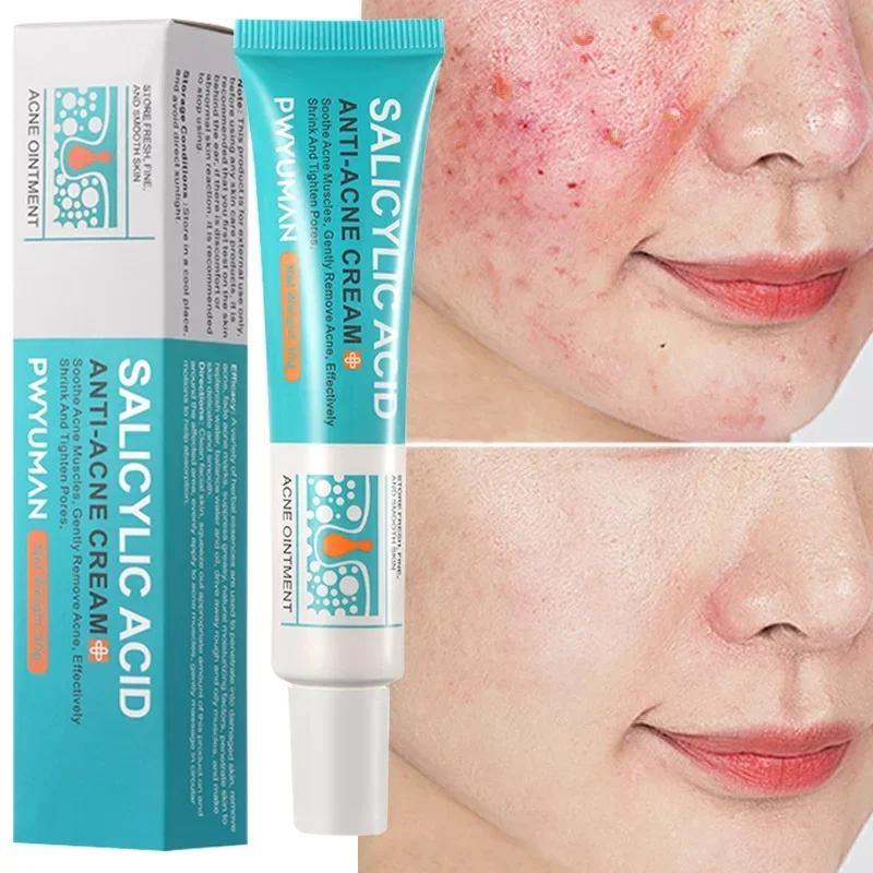 Salicylic Acid Acne Treatment Cream Repair Pimple Spots Deep Cleaning Pore Shrinking Anti-acne Oil Control Moisturizer Skin Care