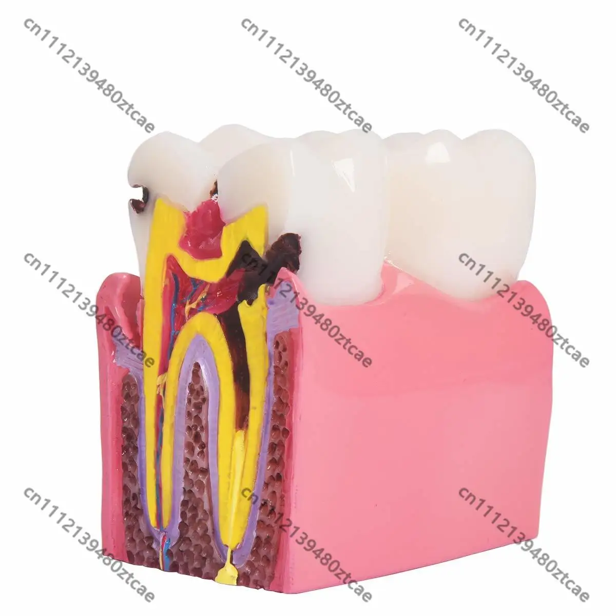1:6 Magnified Dental Caries Model Oral Tooth Anatomy Comparison Model Dentistry Teaching Study Demonstration Tool
