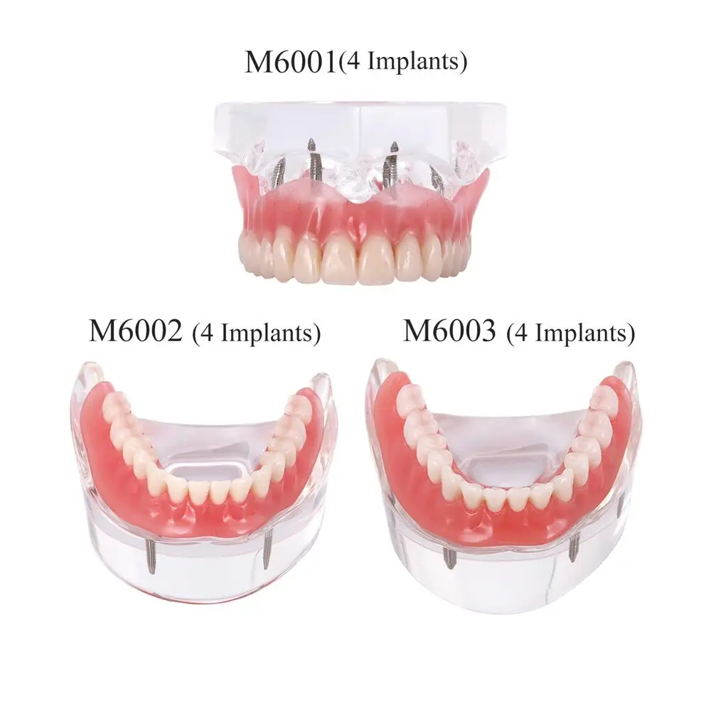 치과 치아 모델, 표준 임플란트 교육 모델, 교정 치과 의사 데모, Kilgore NISSIN 200/500,AG3,Columbia 860