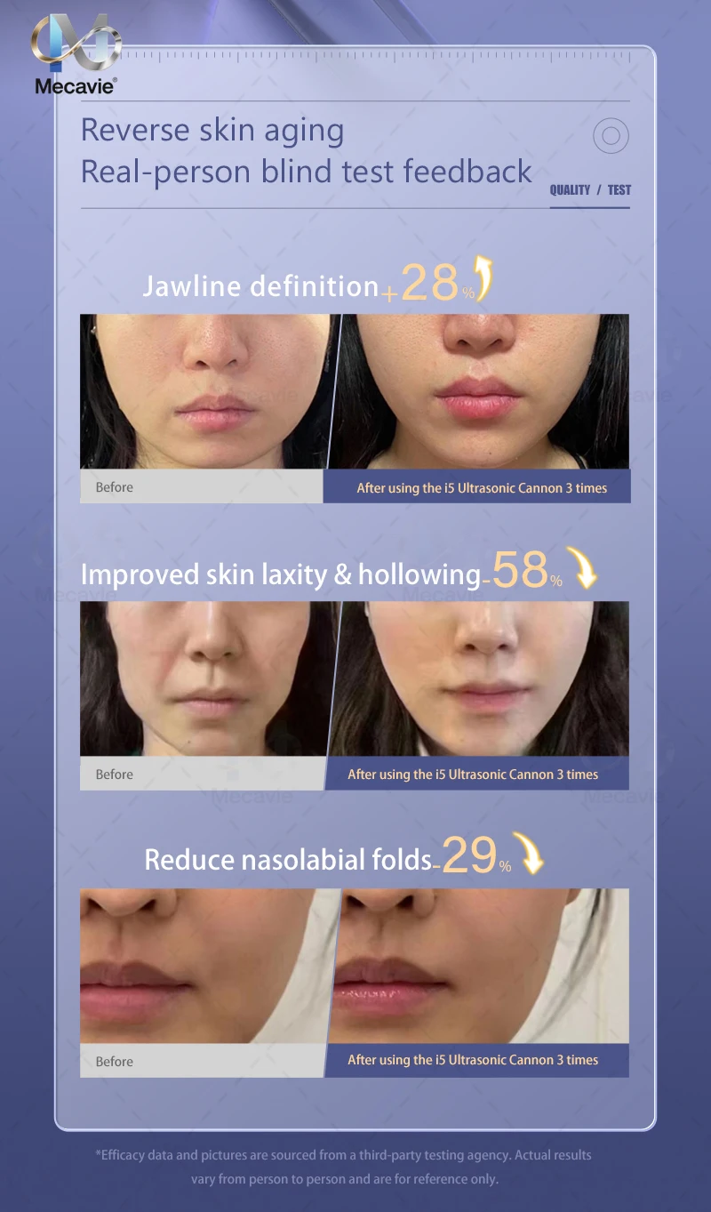 Dernières modèles Appareil de beauté anti-âge à usage domestique pour raffermir le visage, réduire les rides, les pieds d'oie et les plis nasolabiaux