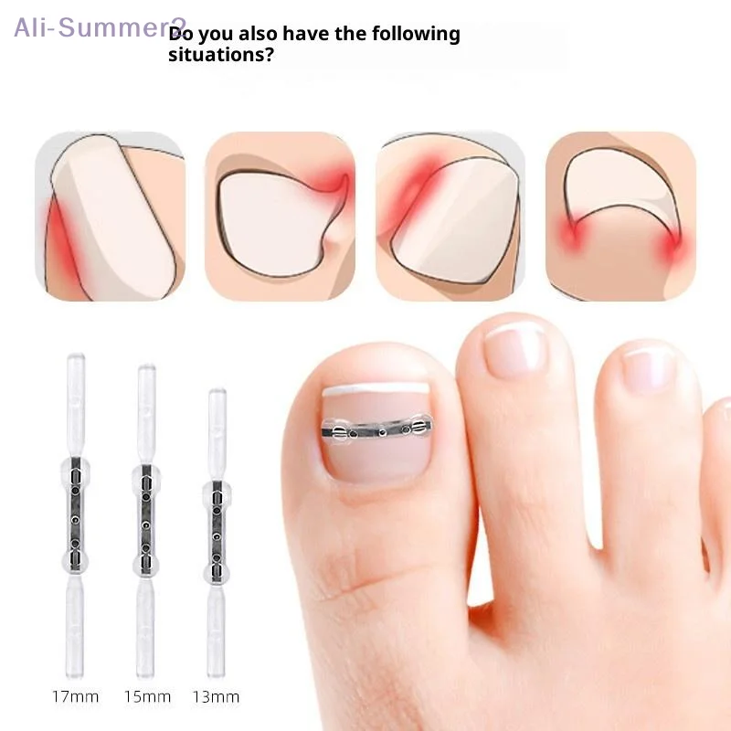 2個入り 13/15/17mm プロ仕様 巻き爪矯正クリップ ブレース 巻き爪矯正ツール 巻き爪治療