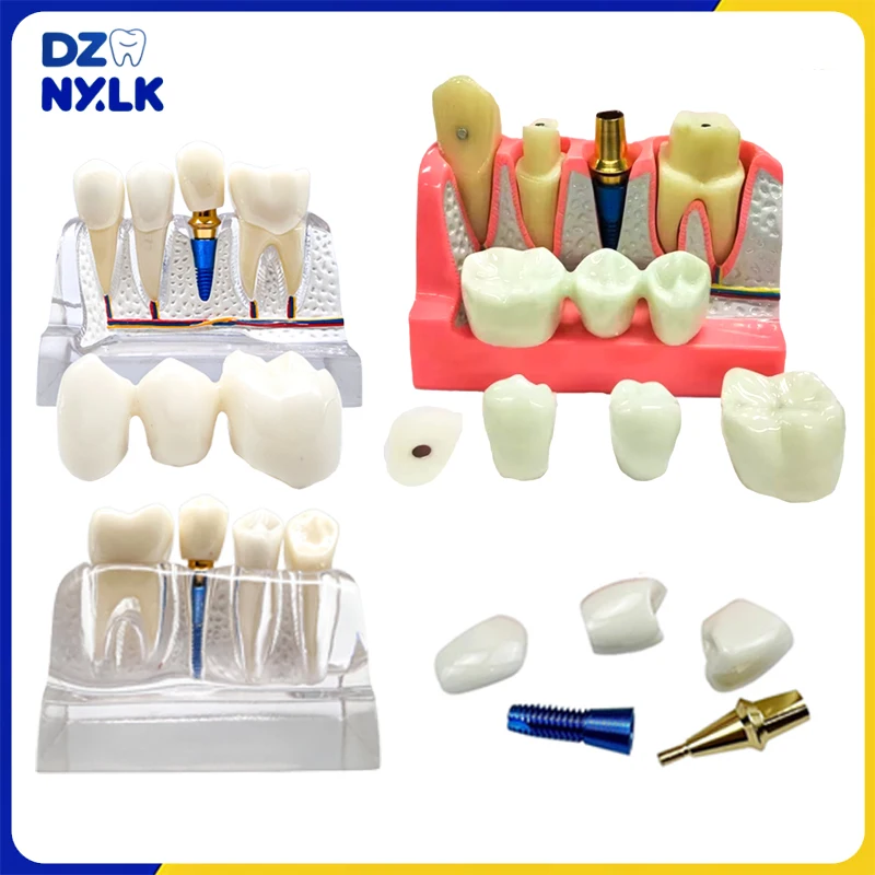 

Зубной имплантат, модель зубов, анализ, коронный мост, демонстрация, съемная фарфоровая модель зубов, обучающая модель стоматолога