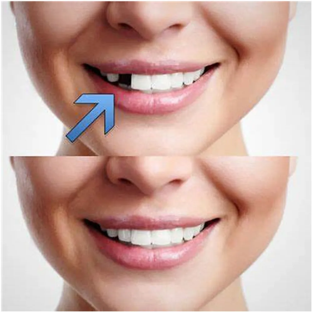 SowSmile New 10pcs Temporary Dental Oral Fake False Snap on Real Instant SmileTeeth Tooth Repair Veneers Kits Building Glue