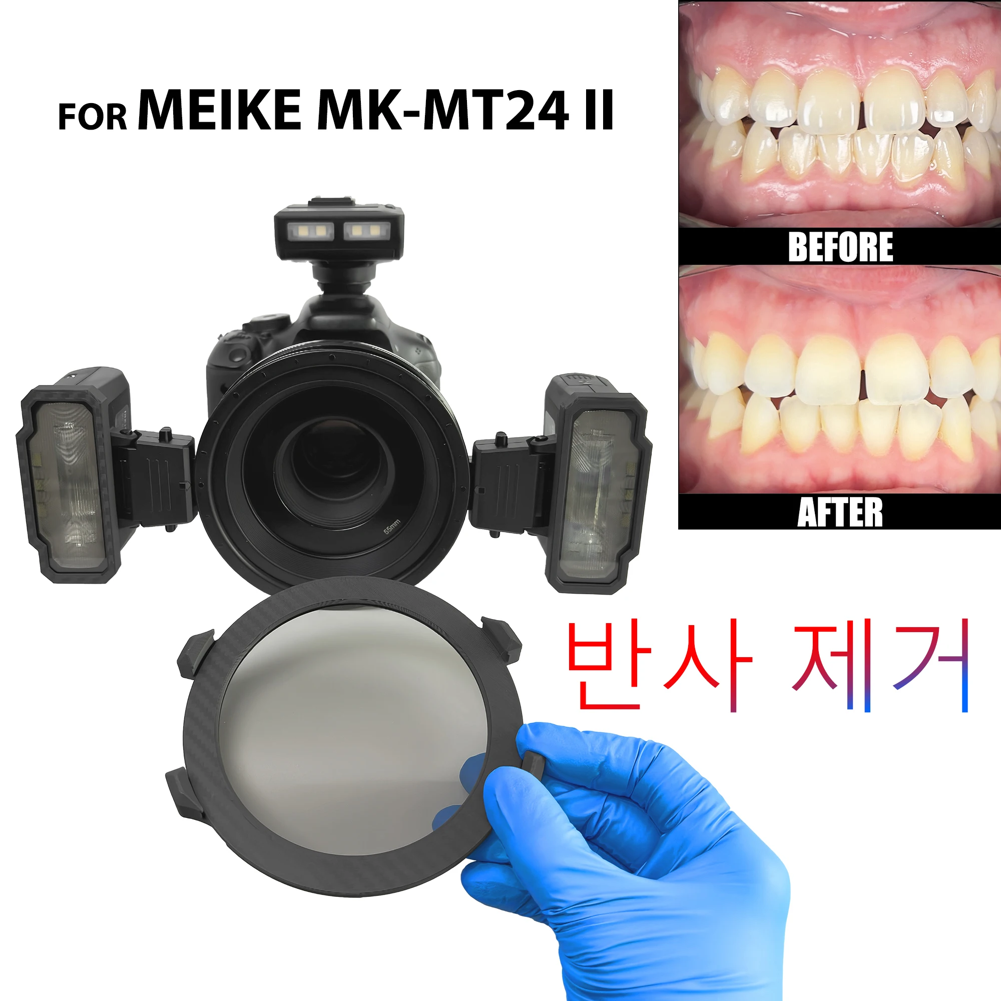 치과 사진. MEIKE MK-MT24 플래시 세트용 CPL 편광 필터 치과 사진 반사 및 눈부심 제거