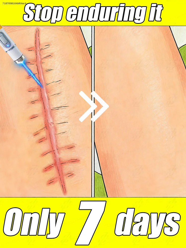 

2026 Hot Sale,Lᴀsᴇʀ sᴄᴀʀ ʀᴇᴍᴏᴠᴀʟ ɪs sᴜɪᴛᴀʙʟᴇ ғᴏʀ ᴀʟʟ ᴋɪɴᴅs ᴏғ sᴄᴀʀs.