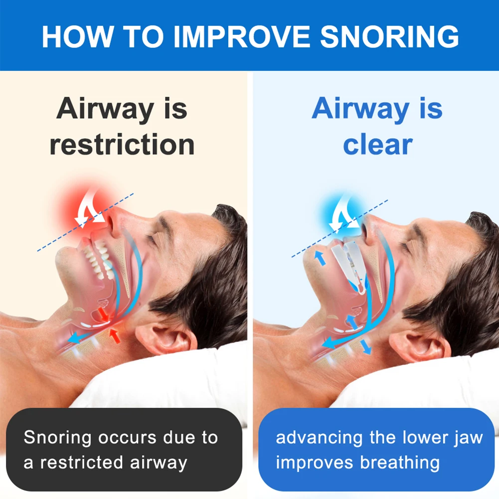 Anti-Snoring Mouthpiece Anti-Snoring Mouth Guard Adjustable Jaw Positioning Reduce Snoring Aid for Bruxism & Stop Snoring