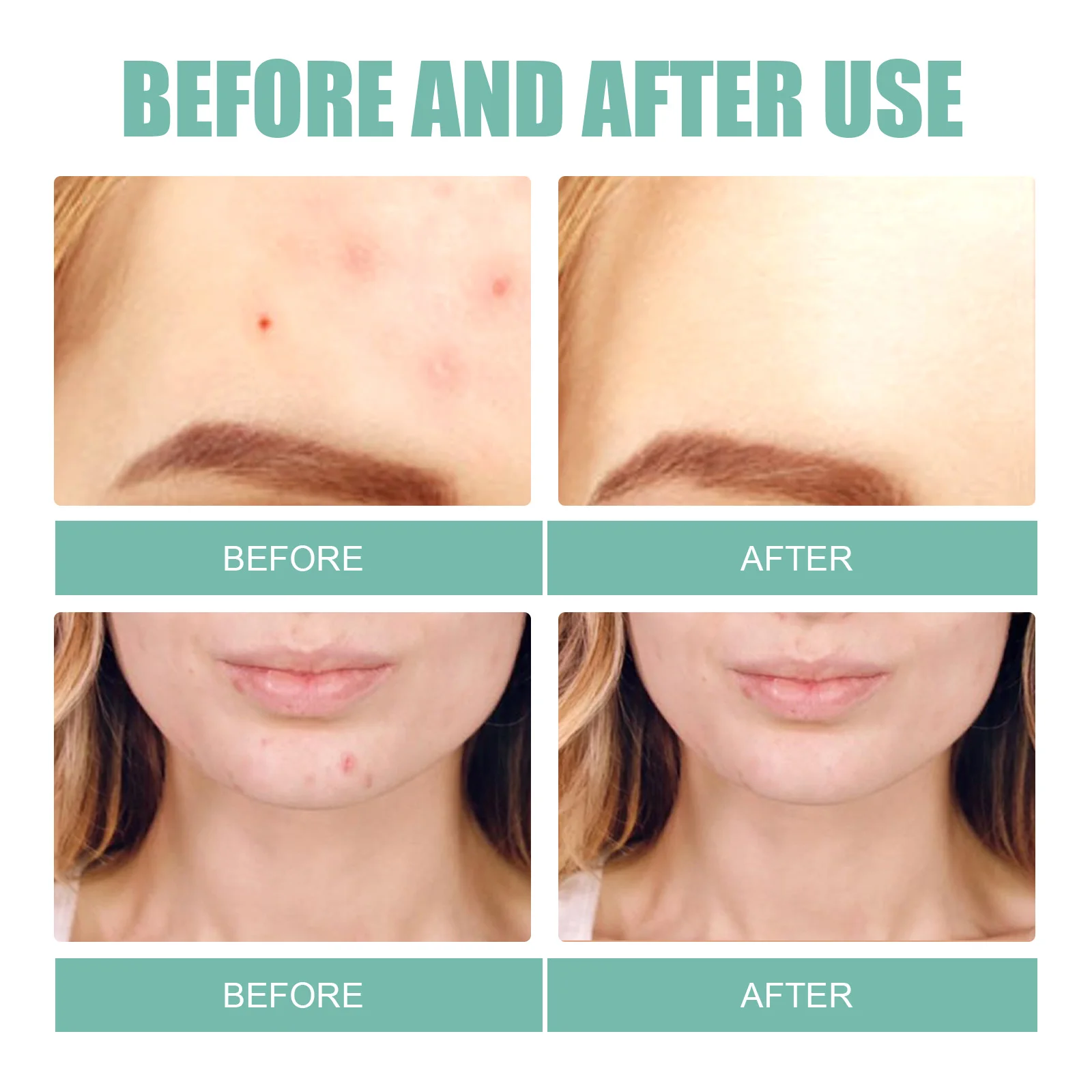 Parches suaves para el acné, tratamiento hidrocoloide calmante para imperfecciones, parches para espinillas respetuosos con la piel para pieles sensibles