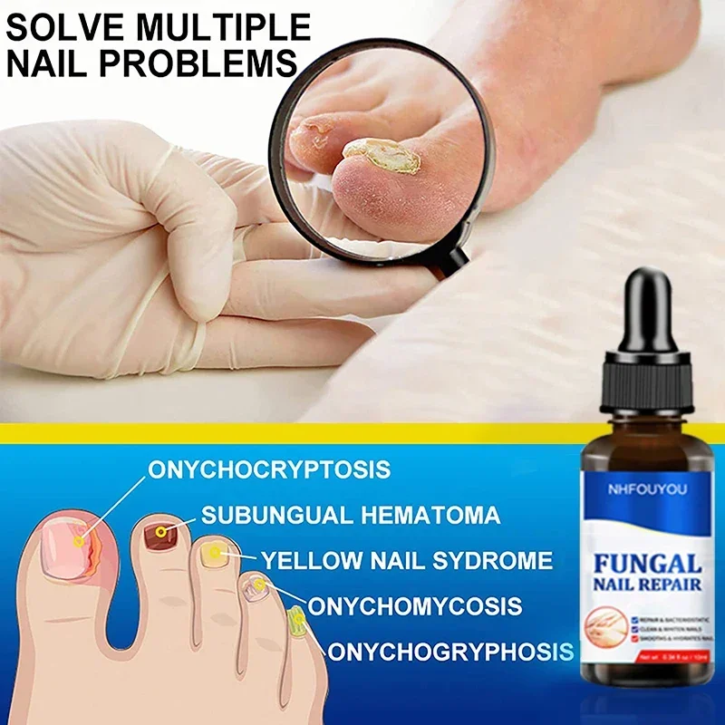 Aceite para tratamiento de uñas por hongos, esencia para reparación de pies, Gel para eliminación de hongos en las uñas de los pies, crema antiinfección, 10ML