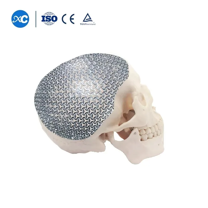 Craneotomo Neurosurgery Maxillofacial Titanium Head 3D Mesh With Tornillos Medullary Fusion Maxillofacial Titanium