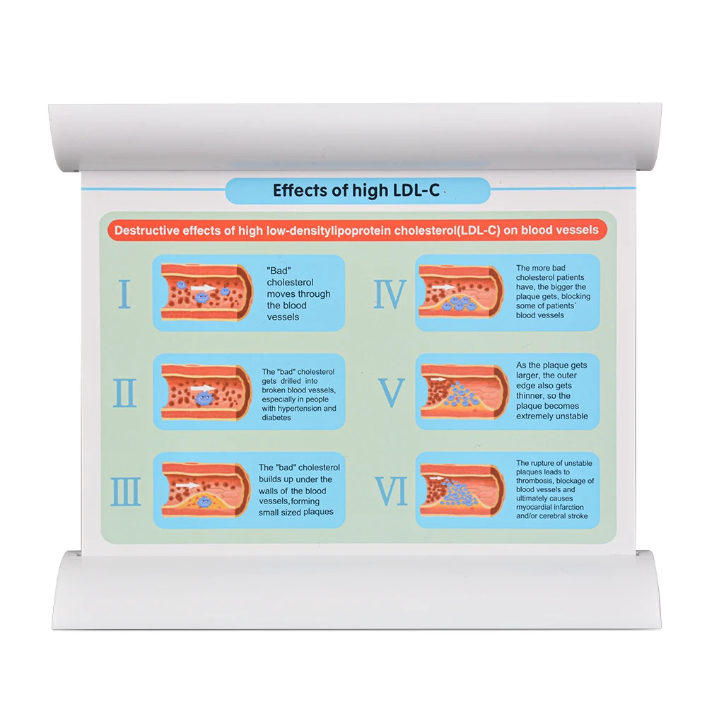 comparison-model-of-fibrous-plaque-xomplicated-plaque-angiemphraxis-normal-blood-vessels