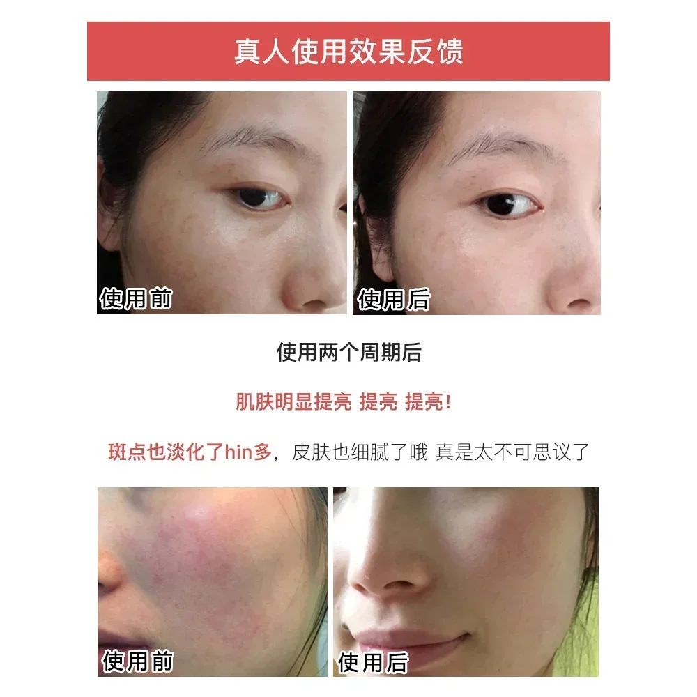 ญี่ปุ่น Freeze-dried Powder Repairing Fade สิว Pits หดตัวรูขุมขนลบสิวหัวดําสิว-Treatment Smoothing Skin Care