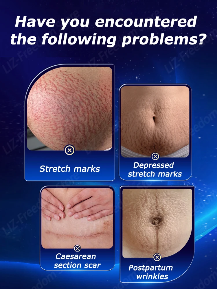 Stretch Mark Cream Reduces Scar Lncrease Skin Elasticity Smoothes Firms