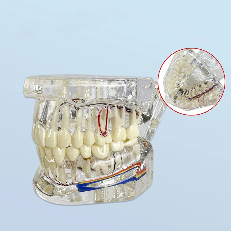 Modelo de restauração dentária, ensino dentário, modelo dentário destacável com modelo ortodôntico nervoso, produtos odontológicos