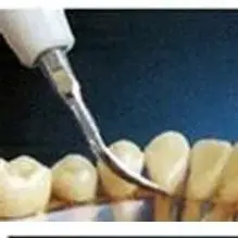 

P1 Стоматологический ультразвуковой скалер, эндодонтический наконечник, подходит для Satelec Woodpekcer Ems Dte, насадка для масштабирования, стоматолог Odontologa, стоматология