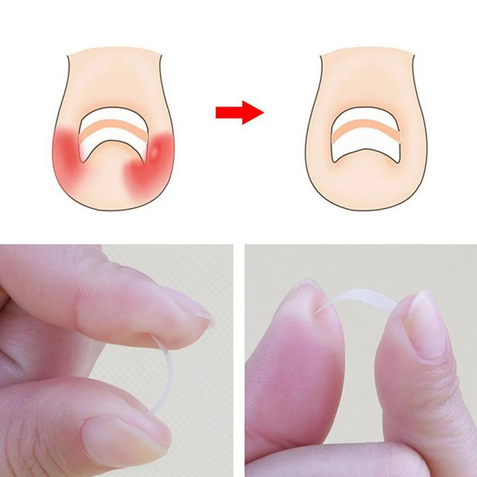 100pcs Paronychia Foot Care Tool Ingrown Nail Correction Patch Corrective Stickers Toenail Strips Correction Patch Nail Sticker